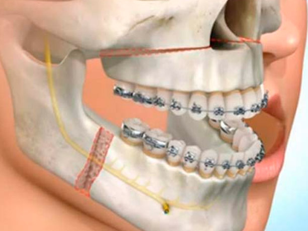 Prognatismo Mandibular o Clase 3 » Cirugía Ortognática - Instituto